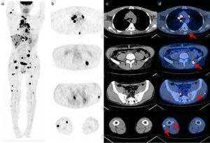Paciente n.° 30: hombre de 39 años con cáncer papilar de tiroides avanzado y múltiples metástasis. Se muestra (a) el estudio PET con proyección de máxima intensidad 3D, (b) los cortes axiales de PET, (c) los cortes axiales de TC y (d) los cortes de fusión PET-TC. Además de las lesiones secundarias en pulmones, mediastino, hígado y otros órganos, con el examen FDG-PET/TC se identificaron 35 metástasis musculares, (d) algunas de ellas señaladas con flechas rojas.