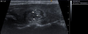 Nódulo tiroideo sólido con múltiples microcalcificaciones (flechas).