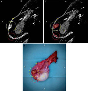 Correlación entre la RM y la macroscopia. (a) Reconstrucción multiplanar de la secuencia ponderada en T1 con gadolinio en RM; (b) fusión con la macroscopia de la RM; y (c) macroscopia de la orquiectomía radical derecha. El círculo amarillo señala una lesión nodular-exofítica localizada en la túnica vaginal, mientras que el círculo rojo identifica la lesión plana localizada en la túnica vaginal.