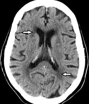 Tomografía computada de cerebro muestra hipodensidad periventricular (flechas) en un paciente añoso.