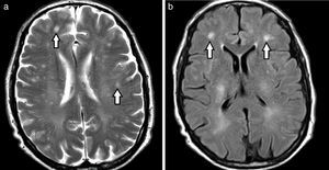 Resonancia magnética de cerebro, corte axial, (a) en ponderación T2 y (b) FLAIR, revela múltiples imágenes puntiformes hiperintensas en la sustancia blanca (flechas).