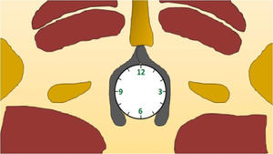 Esquema que muestra la manera de ubicar el trayecto fistuloso en el plano horario: la hora 12 corresponde al periné anterior, la 6 al rafe posterior, la 9 al margen anal derecho y la 3 al margen izquierdo.