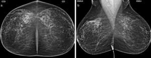 (a) Mamografía de cribado anual anterior, en proyección CC, evidencia glándulas mamarias con ausencia de hallazgos imagenológicos (BIRADS 1). (b) La proyección OML de cribado anual anterior identifica glándula mamaria de apariencia normal (BIRADS 1).