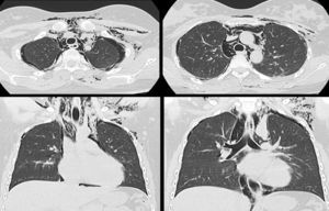 Tomografía computada de tórax en ventana para pulmón muestra burbujas aéreas en el tejido celular subcutáneo, aire en mediastino separando las estructuras anatómicas y neumotórax bilateral.