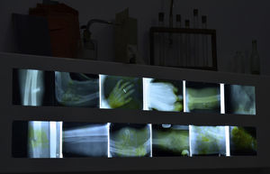 Montaje que muestra radiografías de heridos obtenidas durante la guerra.