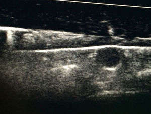 Imagen longitudinal de un lóbulo tiroideo del fantoma, con un nódulo hipoecogénico en su espesor. Sobre el lóbulo tiroideo, otras capas simulan planos musculares y tejido subcutáneo.