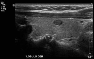 Imagen longitudinal de un lóbulo tiroideo humano, con un nódulo hipoecogénico en su espesor. Compárese la similitud lograda en el fantoma.