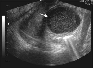 Ecografía endovaginal por dolor pelviano muestra una imagen quística anexial, con líneas finas en su interior que adoptan un patrón reticulado, indicativo de quiste hemorrágico (flecha).