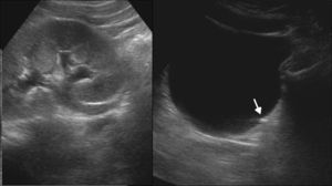 Ecografía por dolor abdominal y hematuria identifica hidronefrosis condicionada por una pequeña litiasis en la unión ureterovesical (flecha).