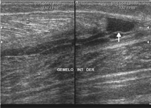 Ecografía muscular por dolor brusco durante la actividad física detecta una colección líquida (hematoma) en la región musculotendinosa del gemelo interno (flecha).