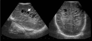 Ecografía transfontanelar revela signos de leucomalacia periventricular con cavidades quísticas periventriculares (flecha).