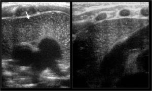 Ecografía transesternal de un recién nacido: nótese la apariencia normal del timo (flecha), homogéneo y sin compresión de las estructuras vasculares.