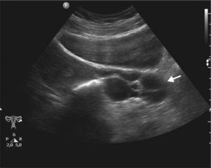 Ecografía ginecológica transabdominal por dolor pelviano identifica dilatación tubaria izquierda, correspondiente a un hidrosalpinx (flecha).