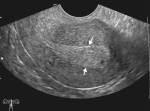 Ecografía ginecológica endovaginal de una paciente posmenopáusica con sangrado ginecológico muestra un engrosamiento endometrial de límites definidos (flechas), con algunas imágenes microquísticas en su interior, compatible con hiperplasia endometrial.