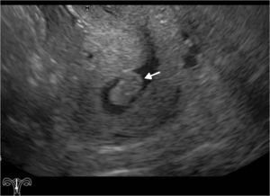 Ecografía ginecológica endovaginal de una paciente posmenopáusica con sangrado ginecológico permite la visualización, por la presencia espontánea de líquido endocavitario, de un engrosamiento focalizado del endometrio (flecha), compatible con pólipo endometrial.