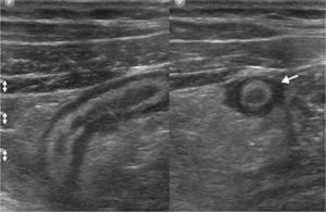 Ecografía abdominal por dolor en la fosa ilíaca derecha muestra las características típicas de un proceso apendicular agudo (flecha). En estos casos el estudio debe completarse con la utilización del transductor lineal para una mejor evaluación de la zona de dolor.