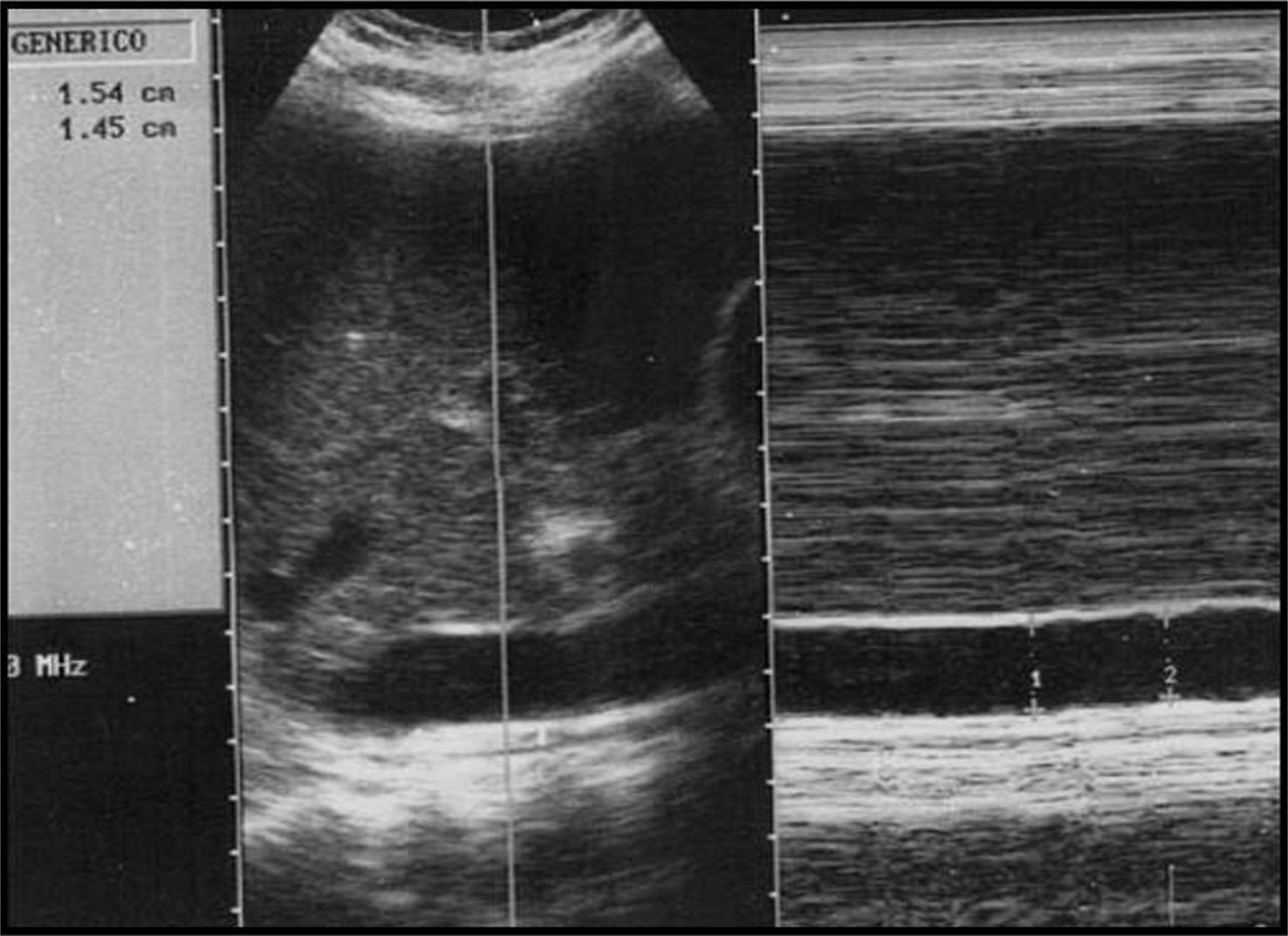 Evaluación ecográfica de la vena cava inferior en los pacientes ...