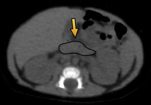 Tomografía computada de abdomen en plano axial muestra un parénquima pancreático delimitado por una línea negra (flecha) de configuración habitual, sin evidencia de lesiones focales.