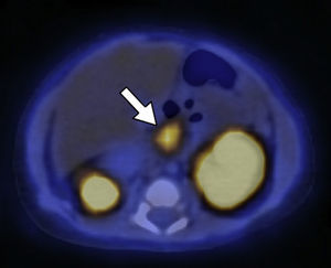 18F-DOPA PET/TC en plano axial del mismo paciente que la Figura 3 muestra una de las zonas de acumulación patológica del radiotrazador localizada en la cabeza pancreática.