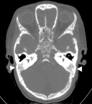 Tomografía computada de la cabeza con ventana para hueso identifica ausencia de neumatización de las celdillas mastoideas (cabezas de flechas).
