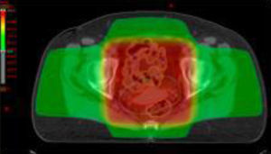 Distribución de dosis según técnica de radioterapia tridimensional conformada.