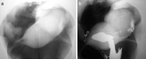 (a) Neumopelvigrafía: quiste en ovario izquierdo. (b) Ginecografía: quiste en ovario izquierdo (archivo C. Gotta).