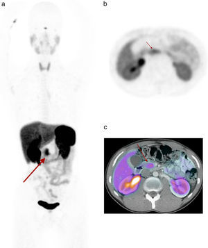 Paciente número 10. Sexo masculino, 21 años. Resección de ganglioneuroma muticéntrico suprarrenal izquierdo. Síndrome de neoplasia endócrina múltiple I. Variante fisiológica del proceso uncinado. (a) Imagen MIP PET captación focal abdominal (flecha), (b) imagen axial PET y (c) fusión PET/TC con contraste i/v: captación focal en proceso uncinado (flecha) SUVmax 12.5.