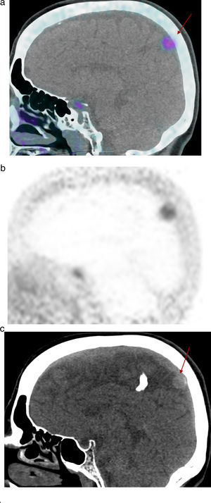 Paciente número 25. Sexo femenino, 69 años. Cáncer de mama bilateral. Axila (+), centellograma óseo (+) en calota. La TC mostró una lesión extra axial. La RM evidenció un proceso expansivo extraaxial, parasagital izquierdo en relación a la hoz del cerebro de 15 mm con realce con gadolinio. Diagnóstico diferencial metástasis/meningioma. Se interpreta como meningioma. (a) Imagen sagital fusión PET/CT, (b) imagen PET sagital: captación focal (flecha) con SUVmax 5.1 y (c) TC en plano sagital, la flecha señala el meningioma.