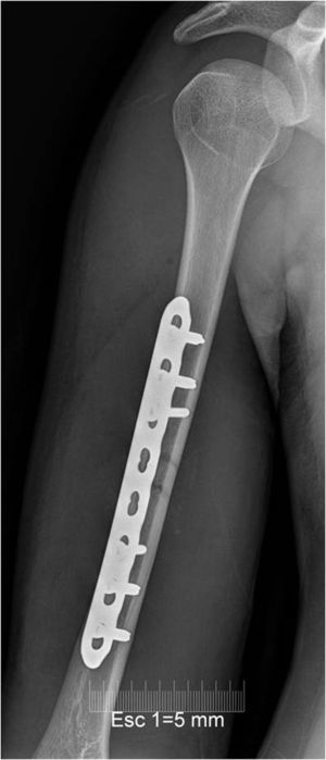 Rx de frente del brazo derecho con placa y tornillos por una fractura diafisaria no desplazada del húmero.