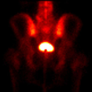 Gammagrafía ósea en proyección posterior de la pelvis muestra hipoactividad en el margen inferior de la vejiga.