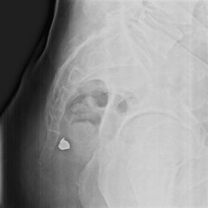 Radiografía pélvica en proyección lateral evidencia un artefacto metálico (bala) en la región presacra.