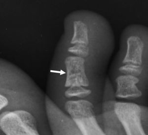 Radiografía oblicua del pie con imagen radiolucente en la falange media del segundo dedo (flecha), que fue interpretada por el médico de urgencias como una fractura en la primera valoración.