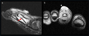 Resonancia magnética de dedos, (a) en corte sagital y en ponderación T2 STIR, muestra un extenso edema de la médula ósea (flecha) y de partes blandas adyacentes.; mientras que (b) el corte coronal en ponderación T1 tras contraste intravenoso evidencia una lesión expansiva del tejido celular subcutáneo (cabeza de flecha), que se extiende involucrando el plano óseo (flecha), con marcado realce. Los hallazgos fueron interpretados como osteomielitis de etiología inespecífica.