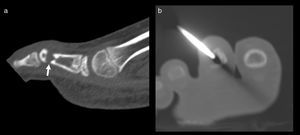 (a) Tomografía computada en corte sagital identifica una lesión osteolítica de la falange media del segundo dedo con disrupción de la cortical y diástasis ósea (flecha). (b) Se realizó una biopsia con guía TC de la lesión.