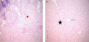 Análisis microscópico de la pieza quirúrgica, con tinción de hematoxilina eosina. (a y b) Visión con distintos aumentos, evidencia una proliferación de células ahusadas de tipo fibroblástico que se disponen en bandas y haces, entremezcladas con tejido colágeno, ocupando espacios medulares y borrando espículas óseas (estrella roja) con extensión por fuera de la cortical en el tejido adiposo y muscular estriado. (b) Se identifica tejido neoplásico con abundante estroma fibrodesmoplásico (estrella negra).
