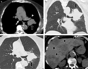 TCMD de una mujer de 83 años de edad con carcinoma de células pequeñas: (a) corte axial de tórax con ventana para mediastino, (b) corte coronal con ventana pulmonar, (c) corte axial con ventana pulmonar y (d) corte axial de abdomen. (a, b y c) Se observa una adenomegalia subcarinal (flecha blanca) y una masa pulmonar de bordes lobulados y espiculados (flechas negras) en la región perihiliar izquierda, que produce compresión bronquial (cabeza de flecha). (d) Se identifican múltiples imágenes hipodensas heterogéneas, compatibles con metástasis hepáticas (cabeza de flecha), primer lugar en frecuencia de secundarismo a distancia.