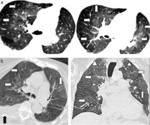 (a) TCMD de tórax en cortes axiales con ventana pulmonar de una mujer de 79 años de edad con edema agudo pulmonar evidencia áreas de aumento de la atenuación en vidrio esmerilado en ambos campos pulmonares, con distribución peribroncovascular y central en “alas de mariposa” (flechas), a diferencia de la neumonía eosinofílica aguda que presenta distribución periférica. (b) Otra paciente con edema pulmonar donde se observan áreas con densidad en vidrio esmerilado de distribución central (flechas blancas), asociadas a engrosamiento de septos interlobulillares (cabezas de flecha) y derrame pleural derecho (flecha negra). Nótese la cardiomegalia.