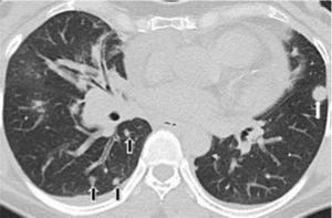 TCMD de tórax en corte axial con ventana pulmonar de una mujer de 53 años de edad con adenocarcinoma pulmonar. Muestra una formación nodular redondeada en el lóbulo inferior del pulmón izquierdo (flecha blanca) y formaciones nodulillares aisladas en ambos pulmones, particularmente en el lóbulo inferior derecho (flechas negras), correspondientes a lesiones metastásicas.
