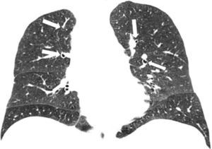 TCMD de tórax en corte coronal con ventana pulmonar de un paciente con bronquiolitis respiratoria asociada a enfermedad pulmonar intersticial identifica engrosamiento de las paredes bronquiales que predominan en los lóbulos superiores (flechas).