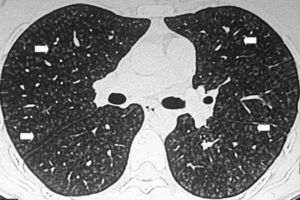 TCMD de tórax en corte axial con ventana pulmonar de un paciente con neumonitis aguda por hipersensibilidad evidencia múltiples opacidades nodulillares en vidrio esmerilado y centrolobulillares distribuidas de forma difusa en ambos pulmones (flechas). Se diferencia de la bronquiolitis respiratoria asociada a enfermedad pulmonar intersticial porque esta presenta menos opacidades centrolobulillares, se asocia generalmente a enfisema centrolobulillar y predomina en los lóbulos superiores.