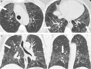 TCMD de tórax con ventana pulmonar de una mujer de 50 años de edad con neumonitis descamativa, en cortes (a) axiales y (b) coronales, evidencia opacidades en vidrio esmerilado de distribución parcheada con predominio periférico y en lóbulos inferiores (flechas).