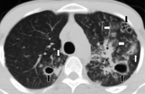 TCMD de tórax en corte axial con ventana pulmonar de un paciente con neumonía por Pneumocystis jirovecii muestra múltiples opacidades en vidrio esmerilado (flechas blancas), asociado a cavidades y formaciones quísticas (flechas negras).