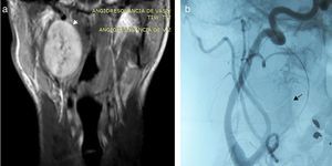 (a) Resonancia magnética en corte coronal y ponderanción T1 con contraste. (b) Angiografía digital identifica la vascularización que presentaba la lesión sólida (flecha).