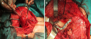 (a) Imagen quirúrgica muestra parte del procedimiento de extirpación de la lesión tumoral. (b) Cierre de la lesión con material de osteosíntesis.
