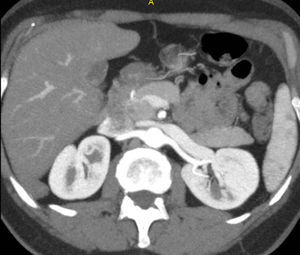 Corte axial de angiotomografía renal (ATR) de un donante con Máxima Intensidad de Proyección (MIP), sin variantes anatómicas. Se evidencia una única arteria renal principal, sin arterias polares ni anomalías de calibre.