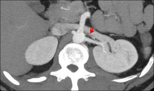 Corte axial de ATR con MIP de donante vivo. Se observan 2 arterias renales que ingresan al hilio, aquella de localización anterior de fino calibre (flecha).