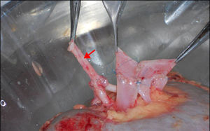 Imagen de la ablación renal, donde se realizó una anastomosis “en caño de escopeta” (flecha) entre ambas arterias observadas en la figura 4.