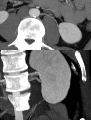 Imágenes de ATR, en axial y coronal, ambas con MIP que evidencian la presencia de arteria polar inferior izquierda.