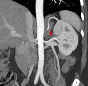 El otro caso discordante del estudio. Aquí, se informó la presencia de una arteria renal accesoria (doble arteria renal) de 1mm emergiendo de la aorta por encima de la arteria renal principal (flecha). En el acto quirúrgico se desestimó su búsqueda debido a su pequeño calibre.