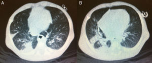 Imagens pulmonares computadorizadas. A) Mostra várias bandas de atelectasia com bronquiectasias e alguns brônquios com paredes espessas. B) Mostra outro espessamento da parede brônquica e inflamação peribronquial e extensa área de condensação subsequente.